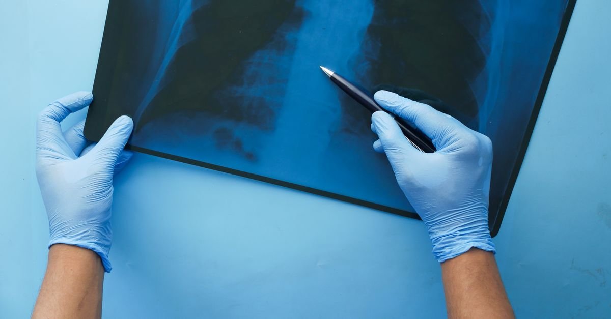 Profissional de saúde com luvas analisa uma radiografia de tórax
